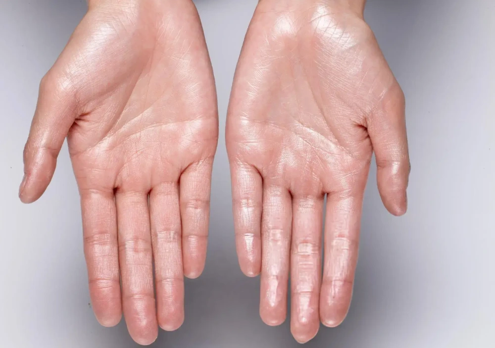 Sweating palms caused by palmar hyperhidrosis