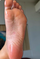 Underarms (white shirt) – Before iontophoresis for armpit sweating – Hidroxa treatment results.