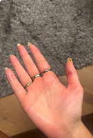 Hands – Before iontophoresis for sweaty hands – Hidroxa treatment results.