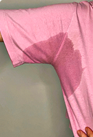 Underarms (pink shirt) – Before iontophoresis for underarm sweating – Hidroxa treatment results.
