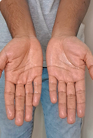 Underarms (white shirt) – Before iontophoresis for armpit sweating – Hidroxa treatment results.