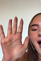 Hands – After iontophoresis for sweaty hands – Hidroxa treatment results.