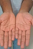 Underarms (white shirt) – After iontophoresis for armpit sweating – Hidroxa treatment results.